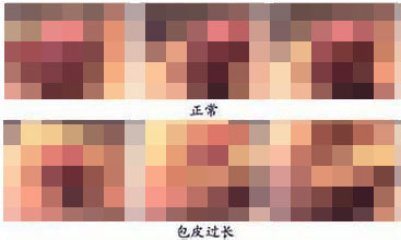 河池男性包皮过长造成的危害有哪些