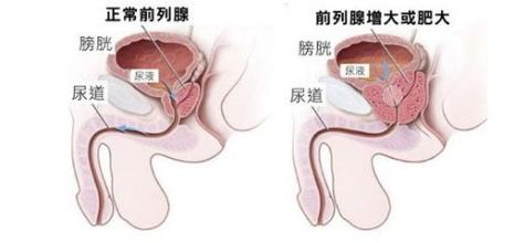 前列腺肥大应如何治疗