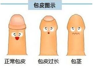 包皮内的白色污垢是怎么回事？