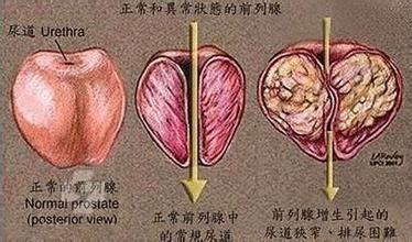 治疗前列腺增生的方法有哪些