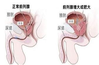 如何判断前列腺增生的轻重?