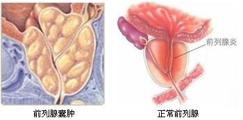 前列腺囊肿对男人生育有影响吗? 前列腺囊肿对男人生育有影响吗?